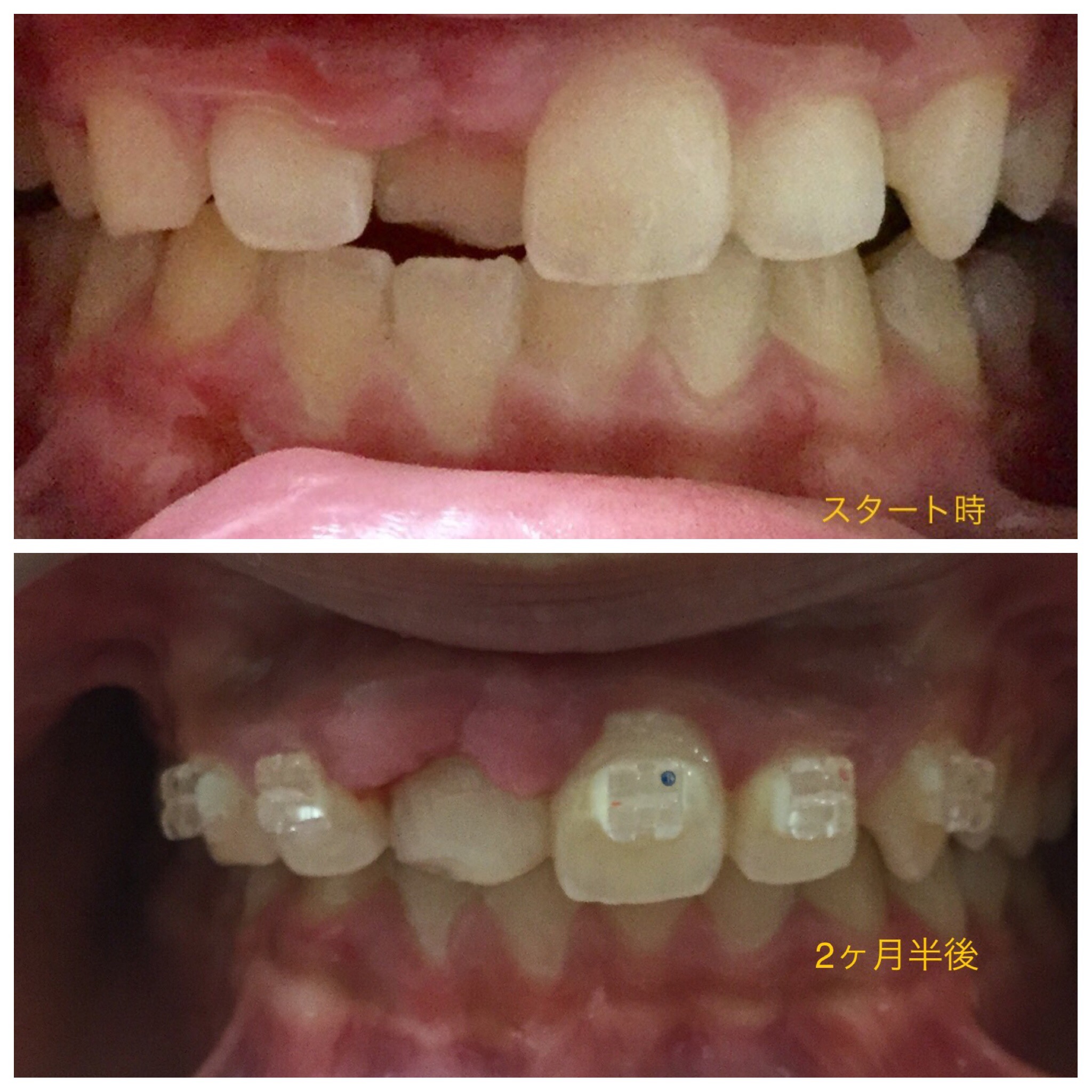 前歯が一本だけ入り込んだ症例（2ヶ月半後）