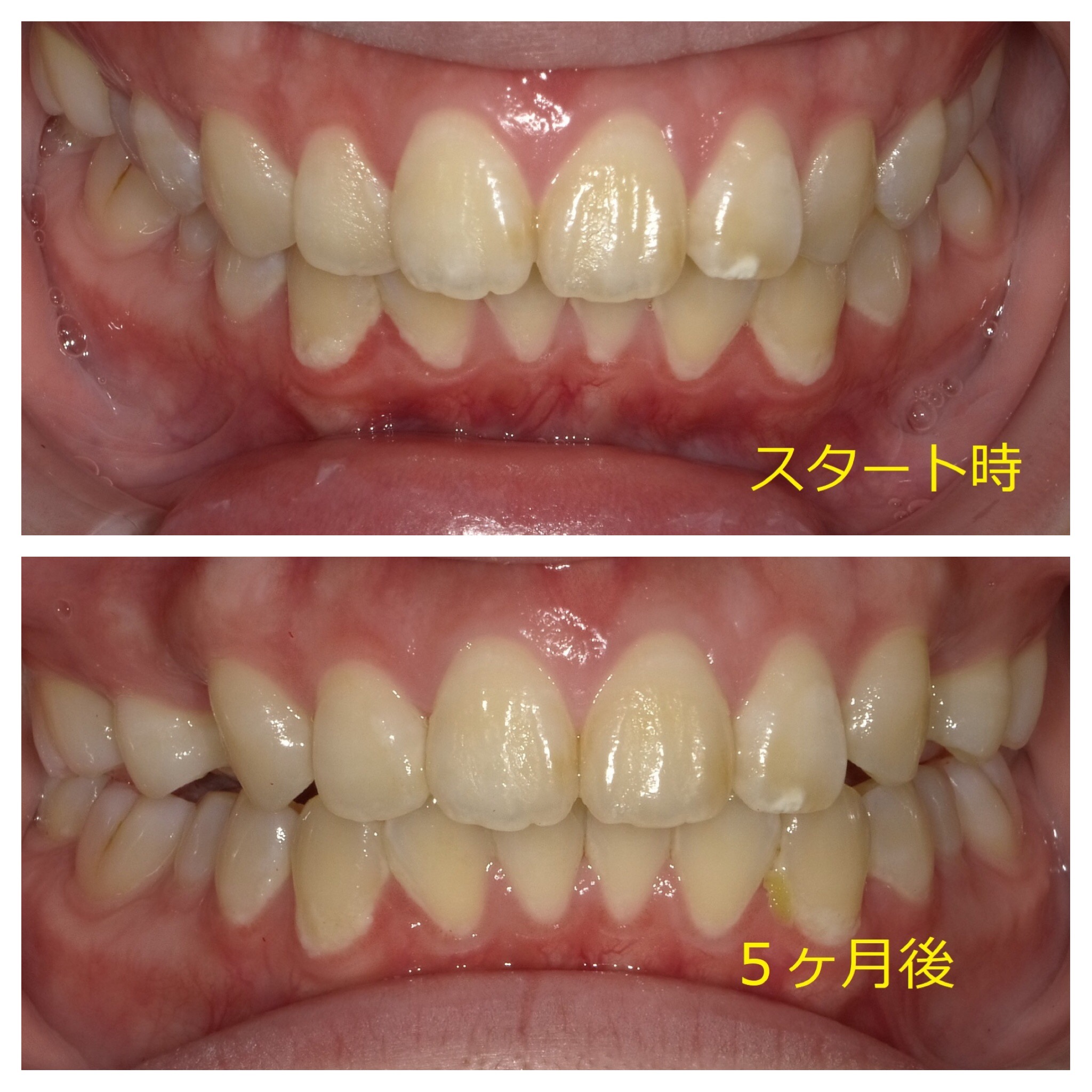 上顎のみの全体矯正。～出っ歯の改善Ⅱ～　④