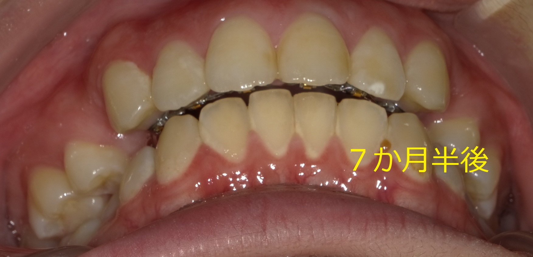 上顎のみの全体矯正。～出っ歯の改善Ⅱ～　⑤