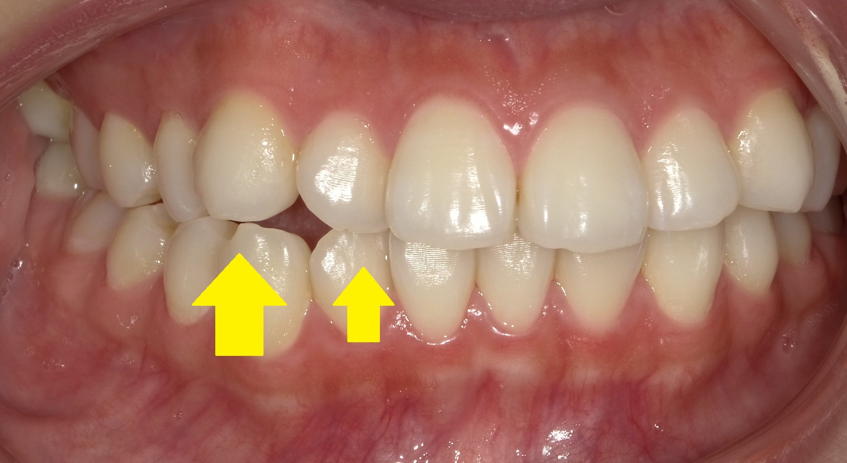 右側の交叉による咬合不全　①
