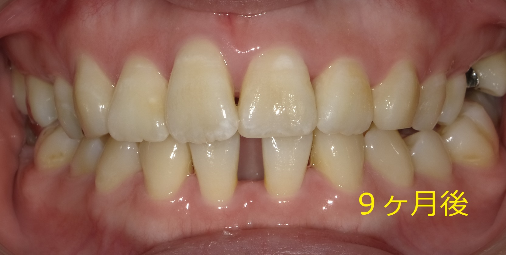 上顎のみ＋欠損スペースを利用しての矯正　⑭