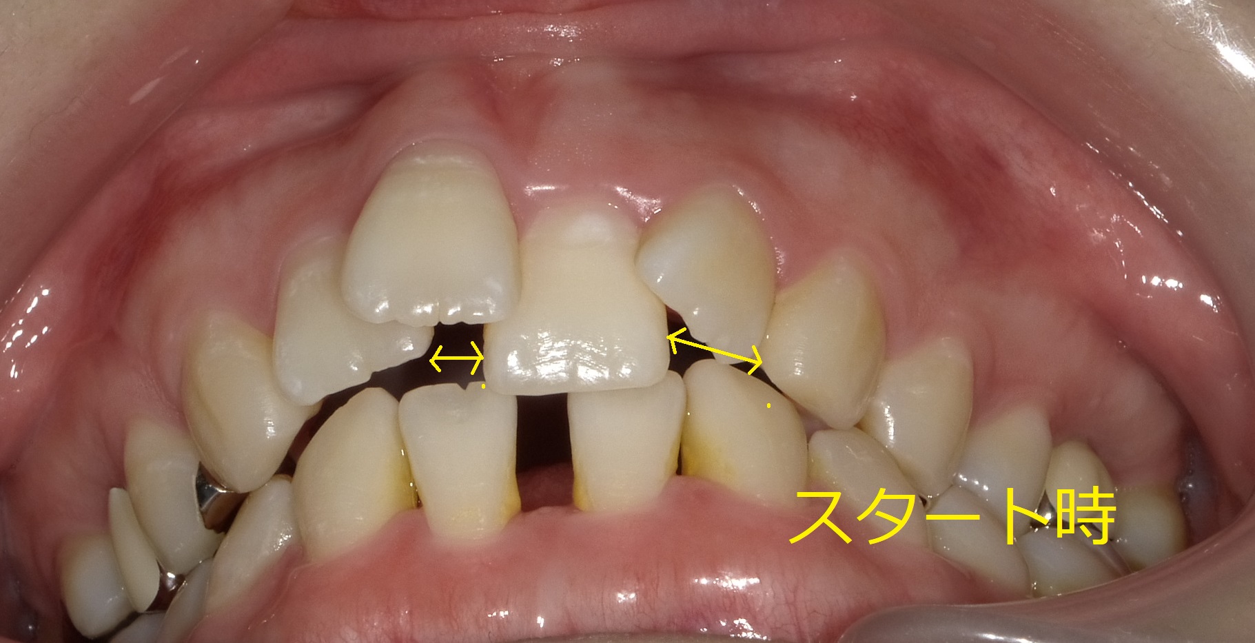 上顎のみ＋欠損スペースを利用しての矯正　⑮