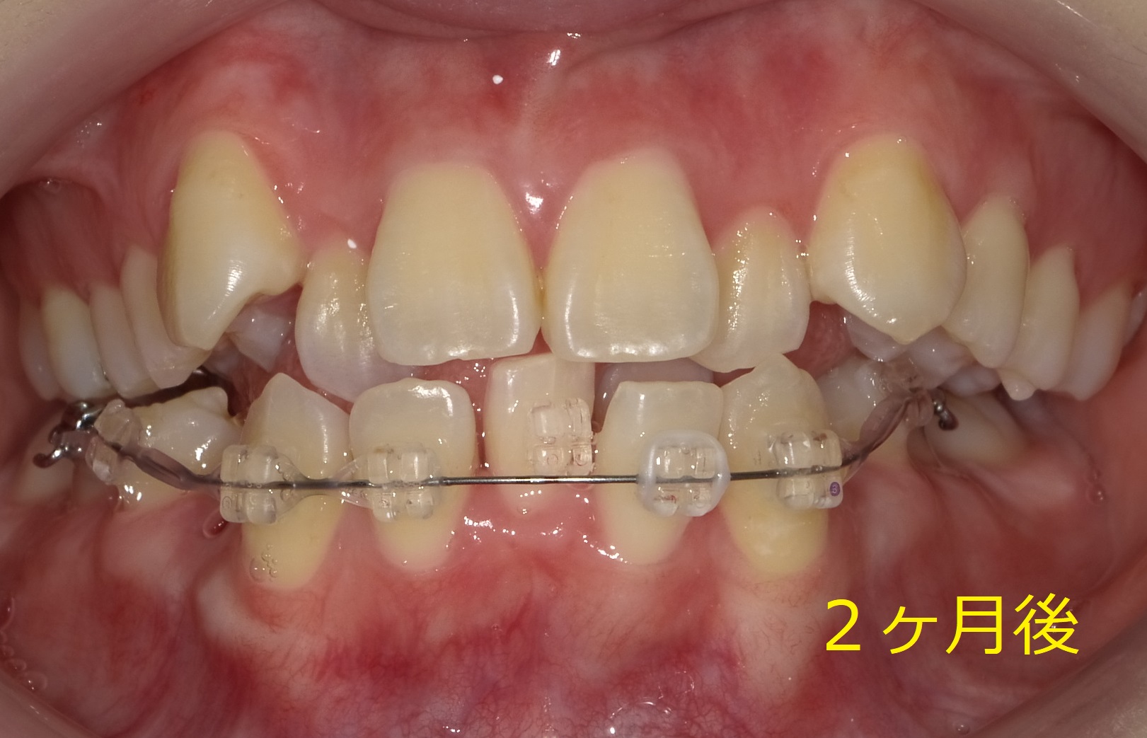 八重歯および左側が噛めていない症例　④