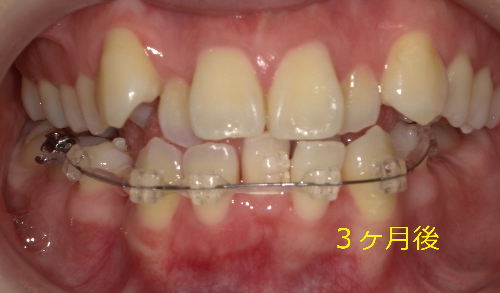 八重歯および左側が噛めていない症例　⑤