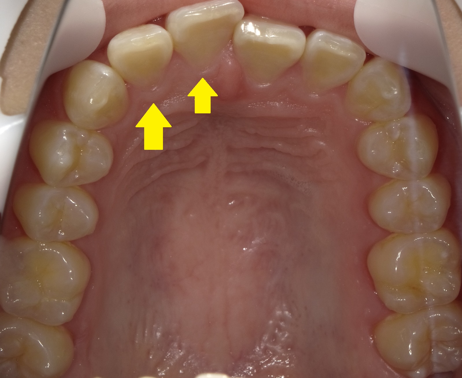 前歯の左半分が受け口の症例　③