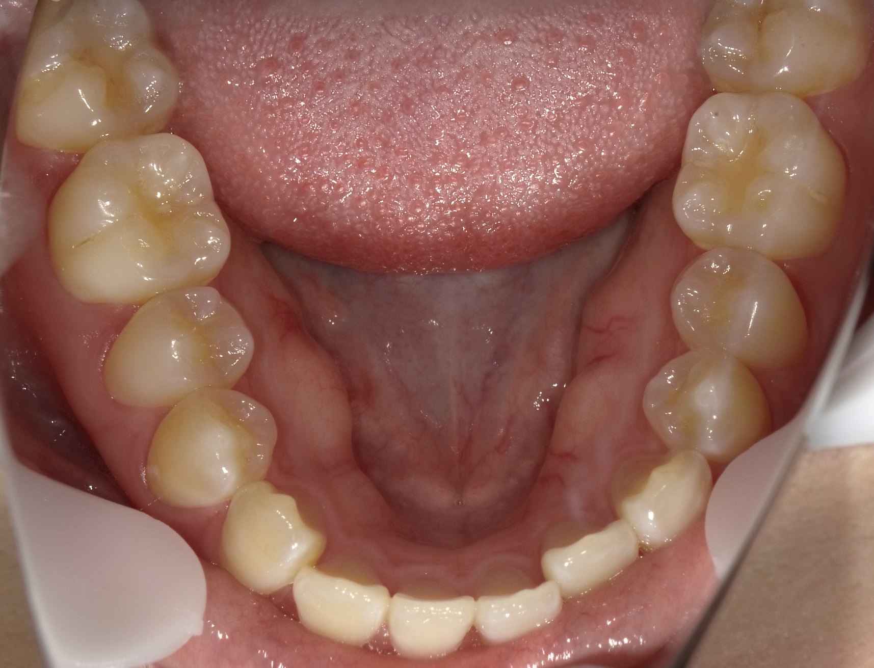 前歯の左半分が受け口の症例　③