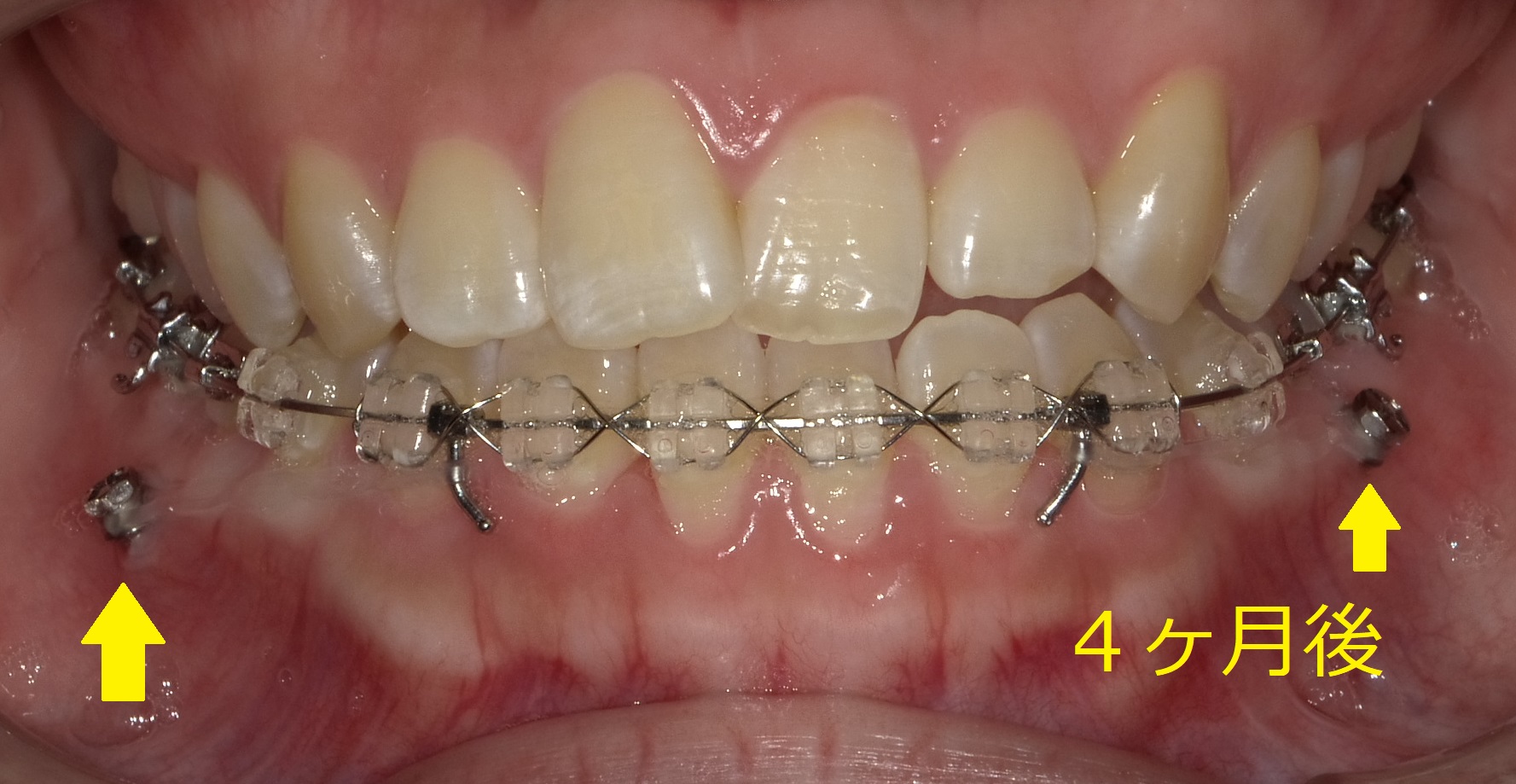 前歯の左半分が受け口の症例　④