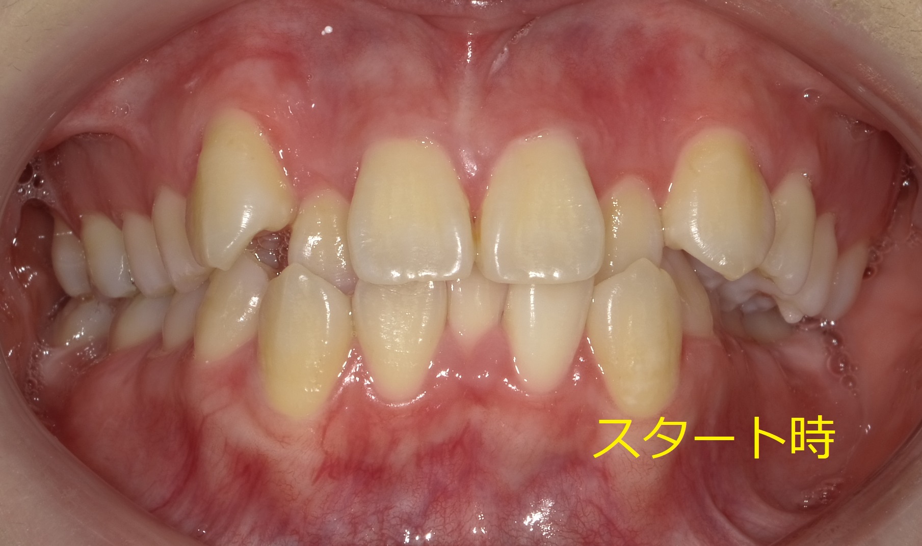 八重歯および左側が噛めていない症例　⑥