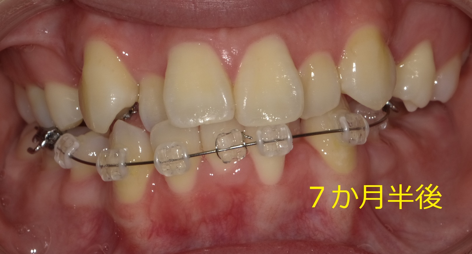 八重歯および左側が噛めていない症例　⑦