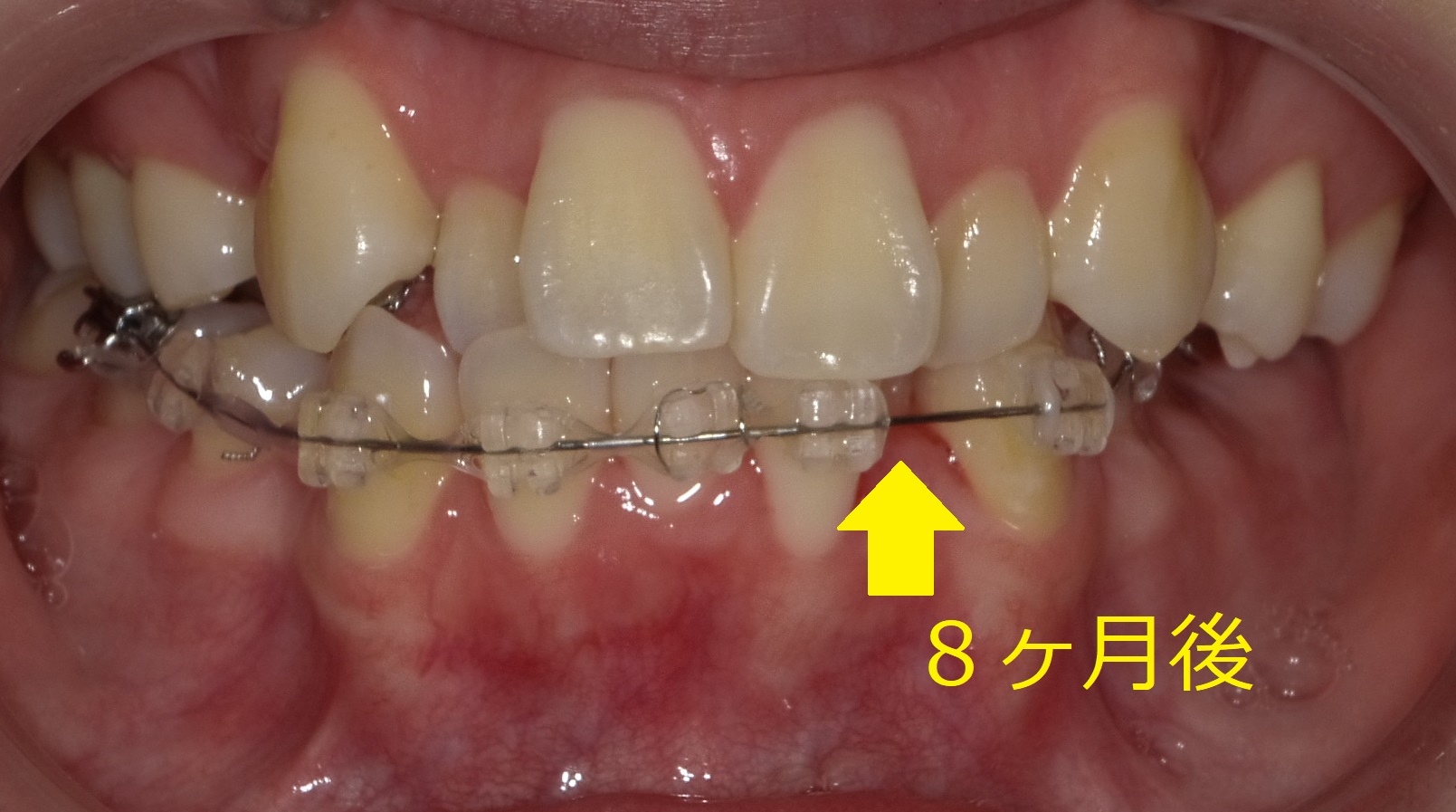 八重歯および左側が噛めていない症例　⑧