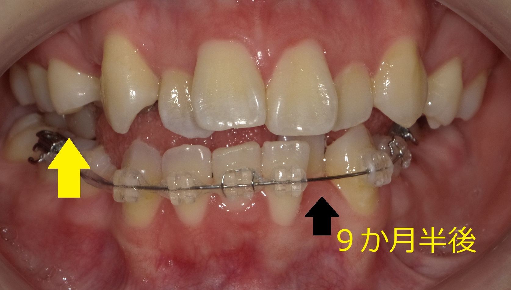 八重歯および左側が噛めていない症例　⑨