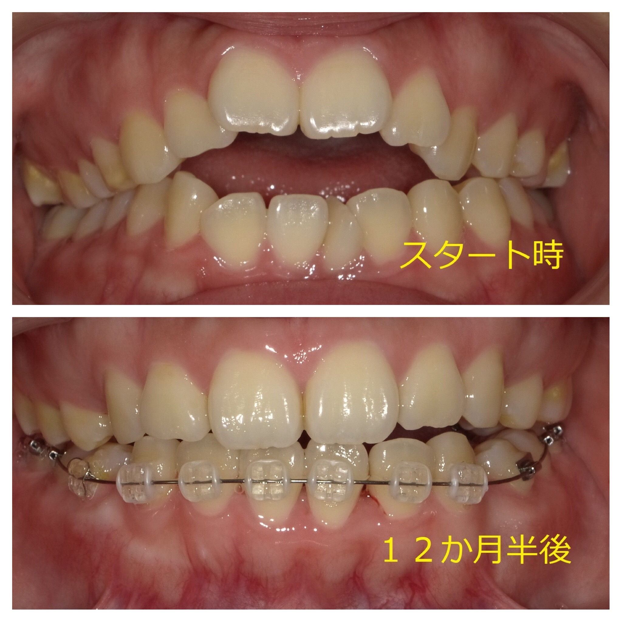 開口（オープンバイト）　⑫