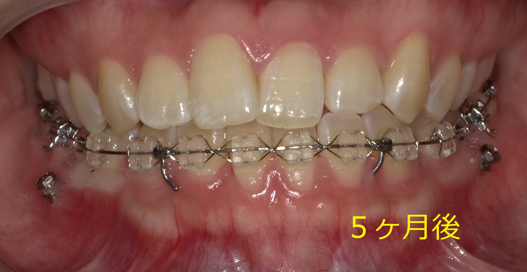 前歯の左半分が受け口の症例　⑤