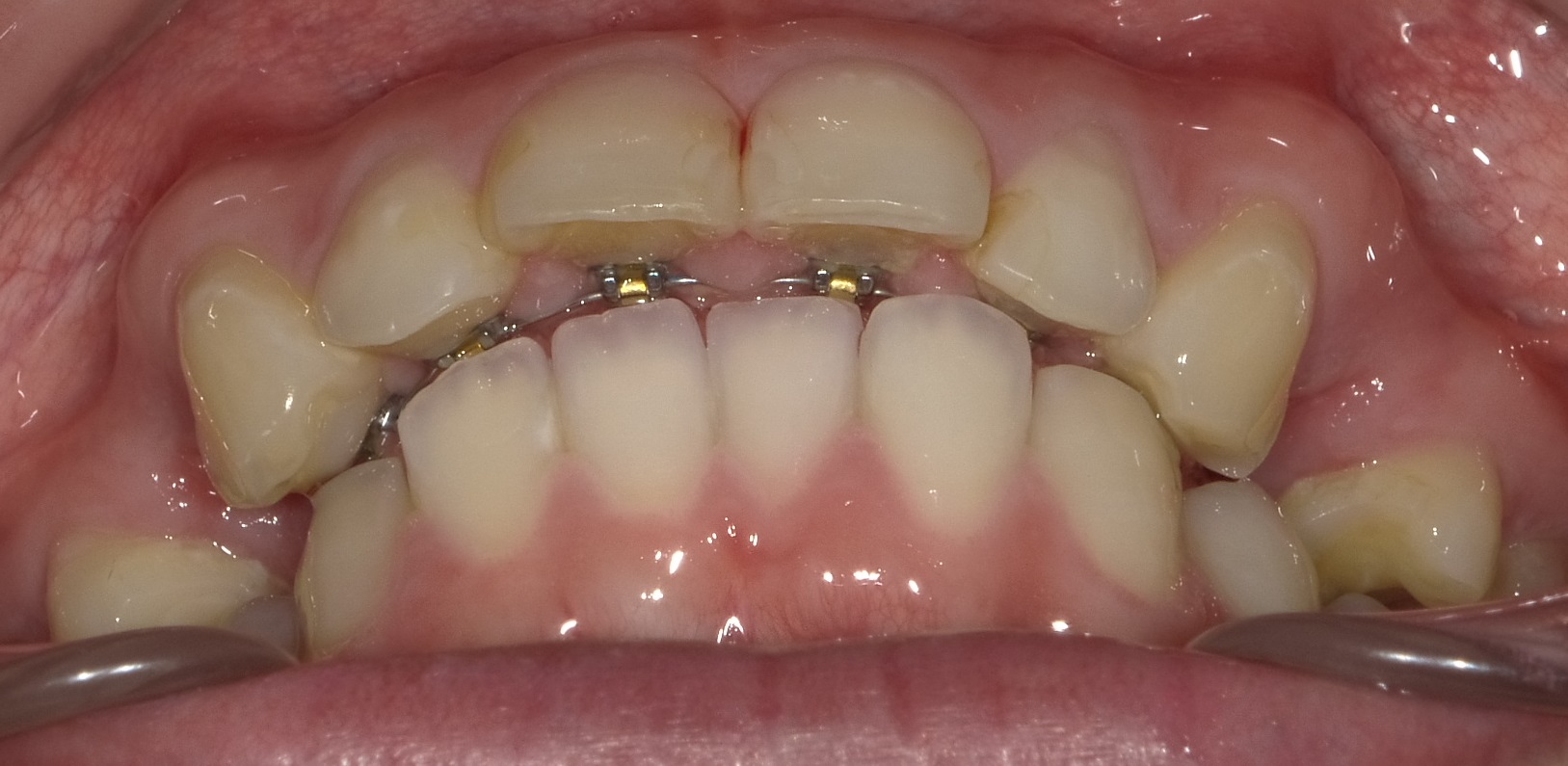上顎のみの全体矯正。～出っ歯の改善～　⑤