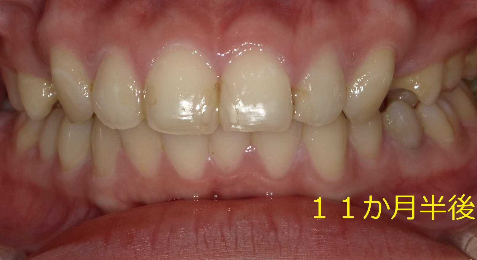 上顎のみの全体矯正。～出っ歯の改善～　⑦