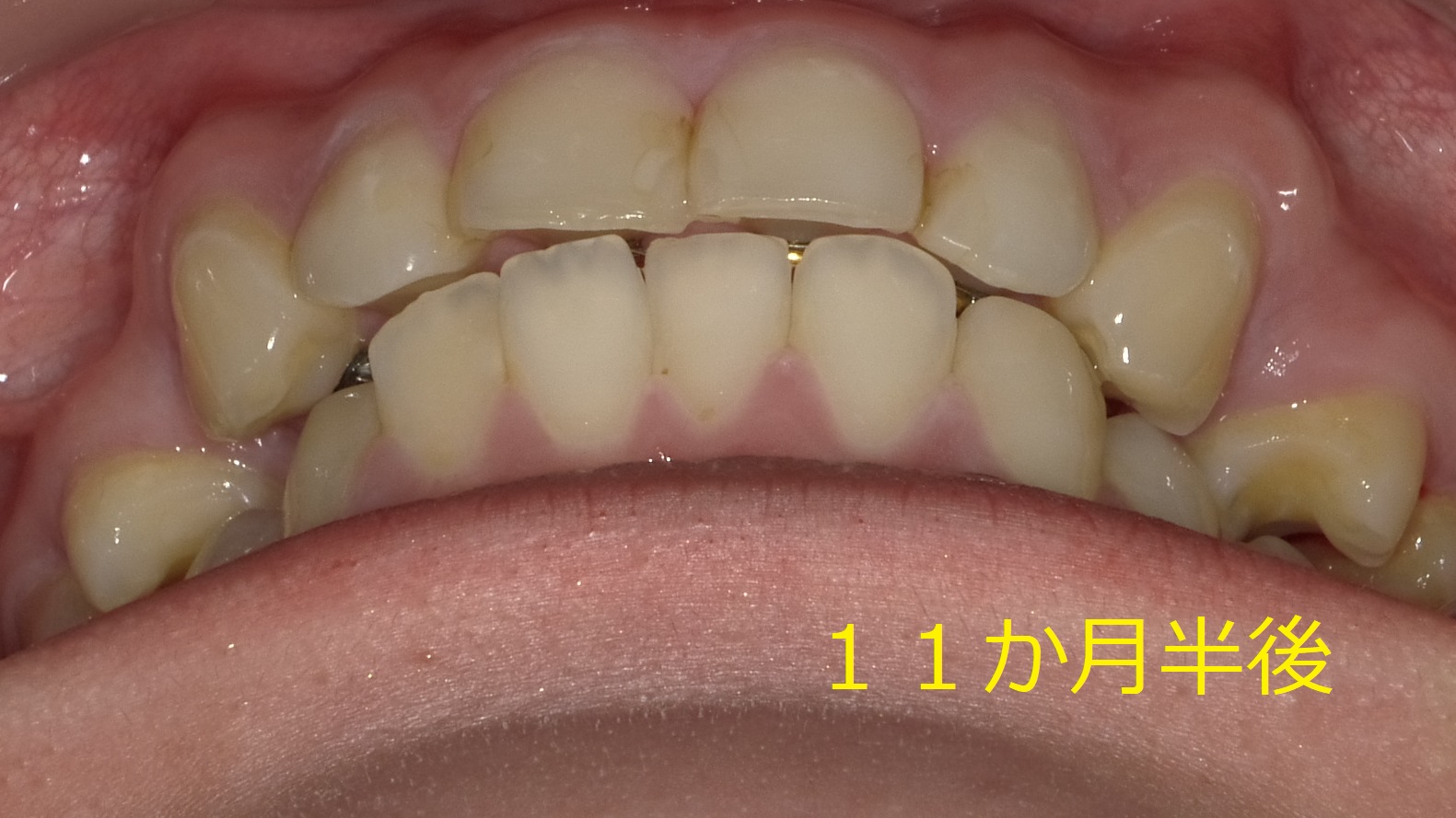 上顎のみの全体矯正。～出っ歯の改善～　⑦