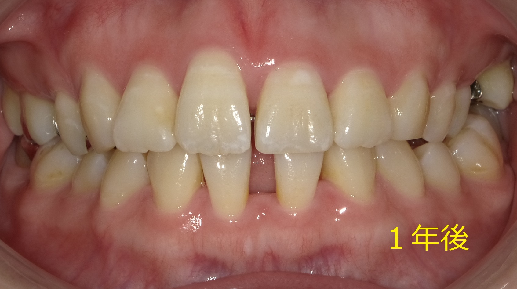 上顎のみ＋欠損スペースを利用しての矯正　⑯
