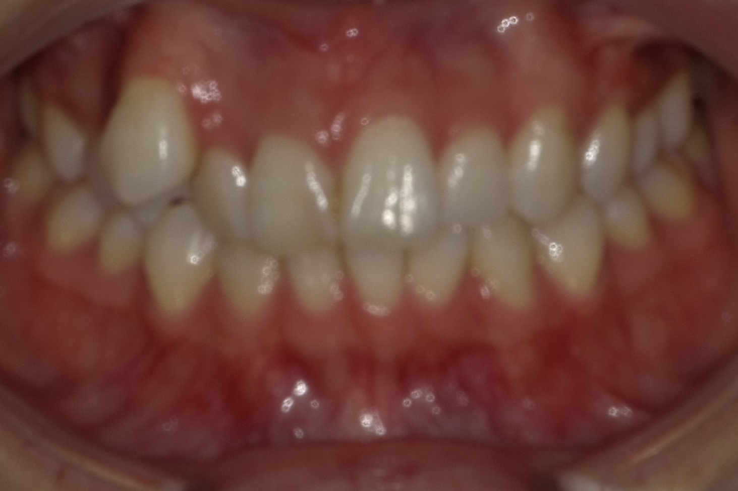 八重歯＋前歯の正中がズレている症例　①