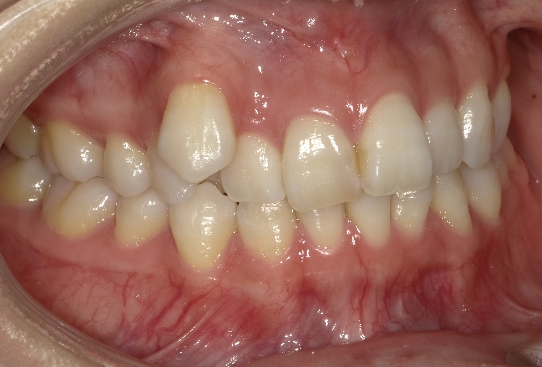 八重歯＋前歯の正中がズレている症例　②