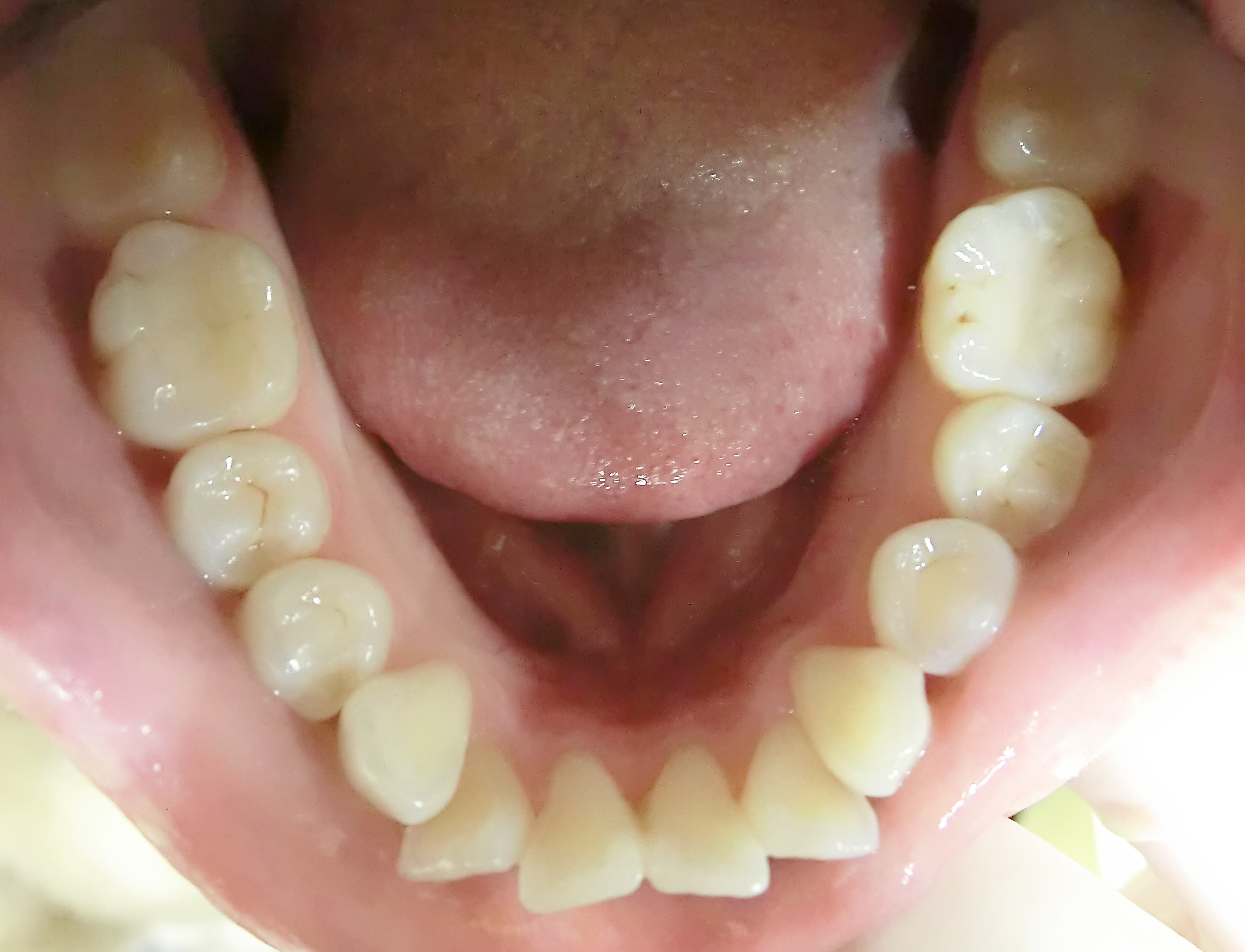 前歯２本が出ている症例。