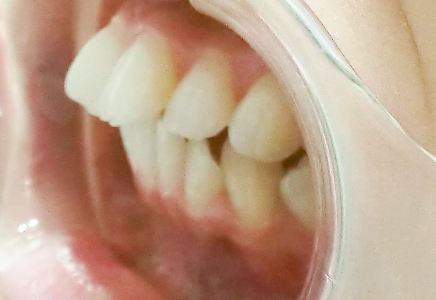 前歯２本が出ている症例。