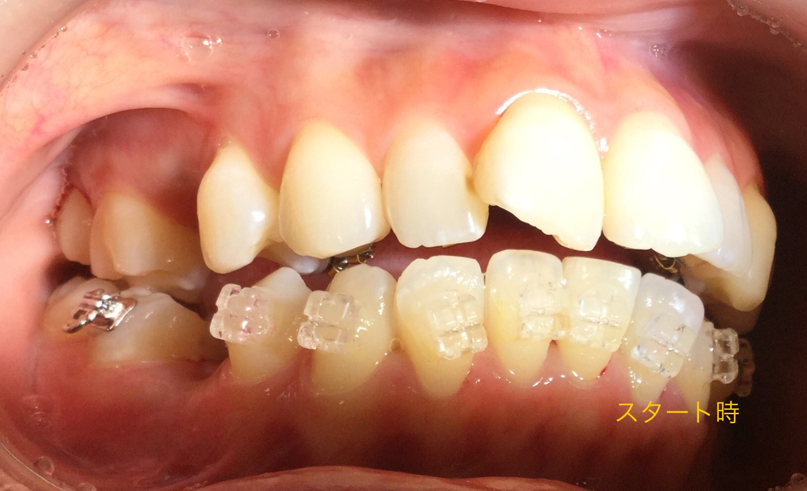 前歯２本が出ている症例（抜歯後）