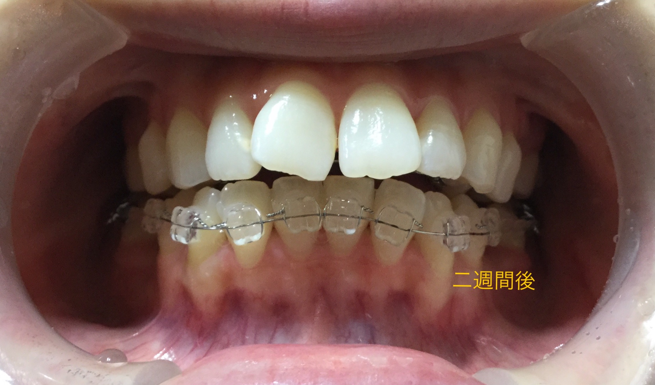 前歯２本が出ている症例（２週間後）