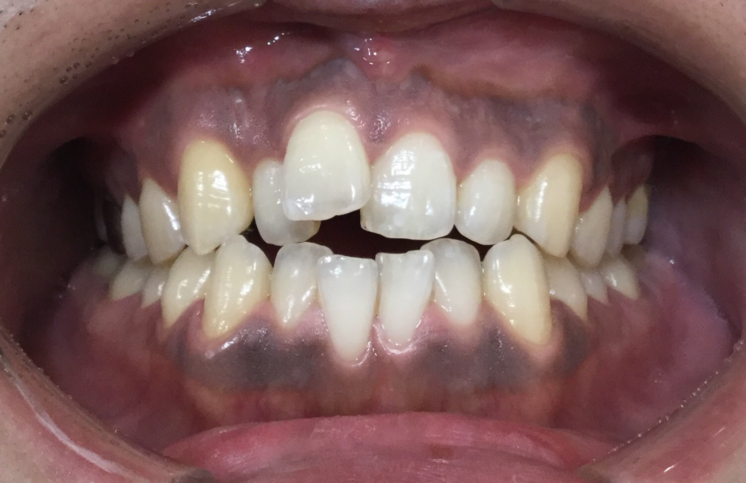 歯茎の色の改善1-1