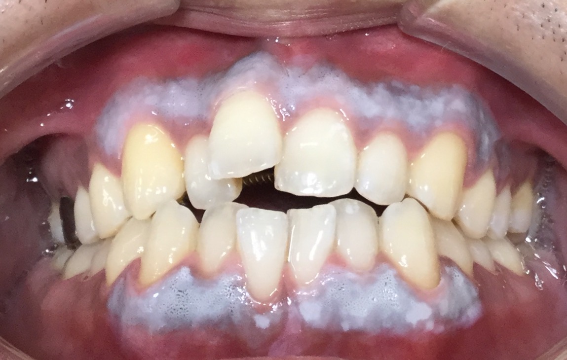 歯茎の色の改善1-1