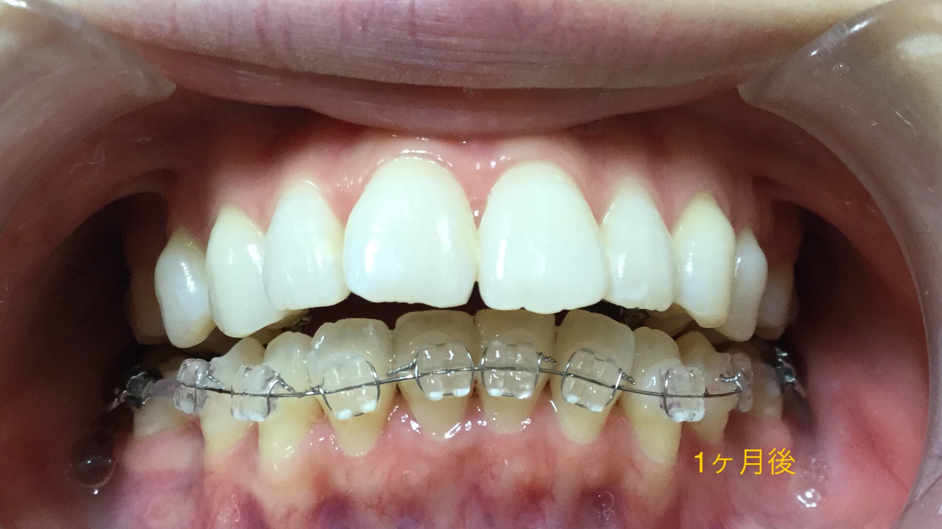 前歯２本が出ている症例（１ヶ月後）
