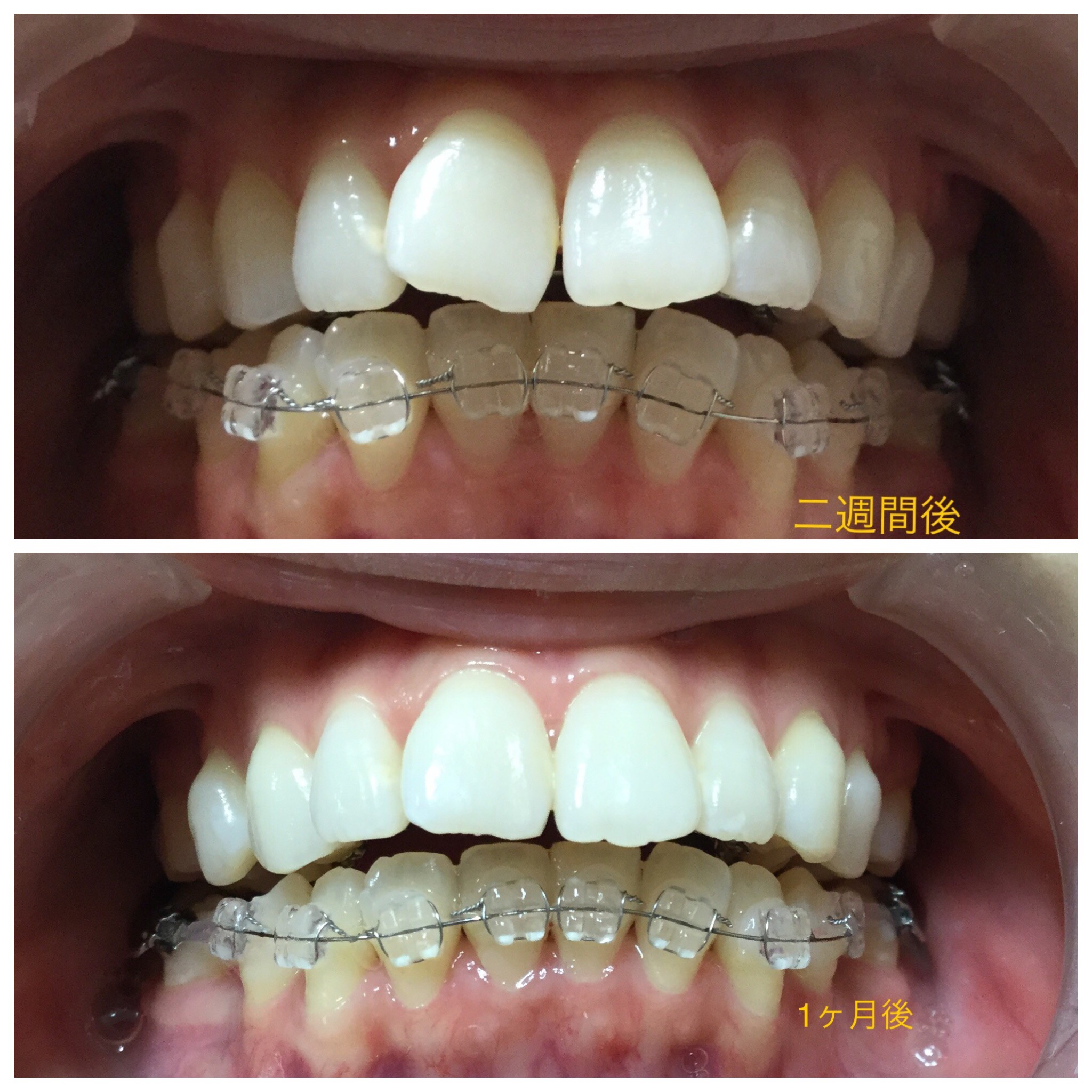 前歯２本が出ている症例（１ヶ月後）