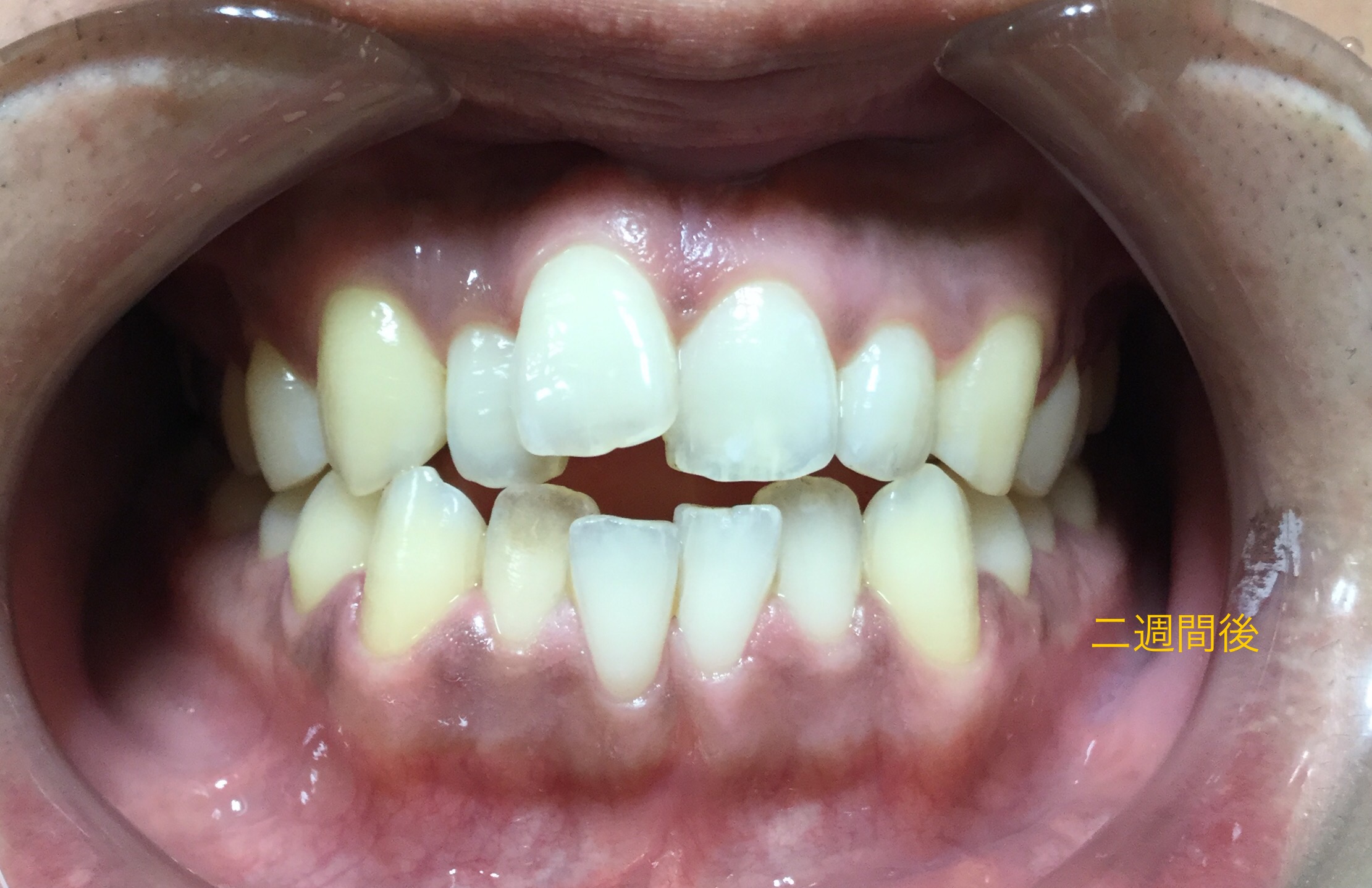 歯茎の色の改善1-2