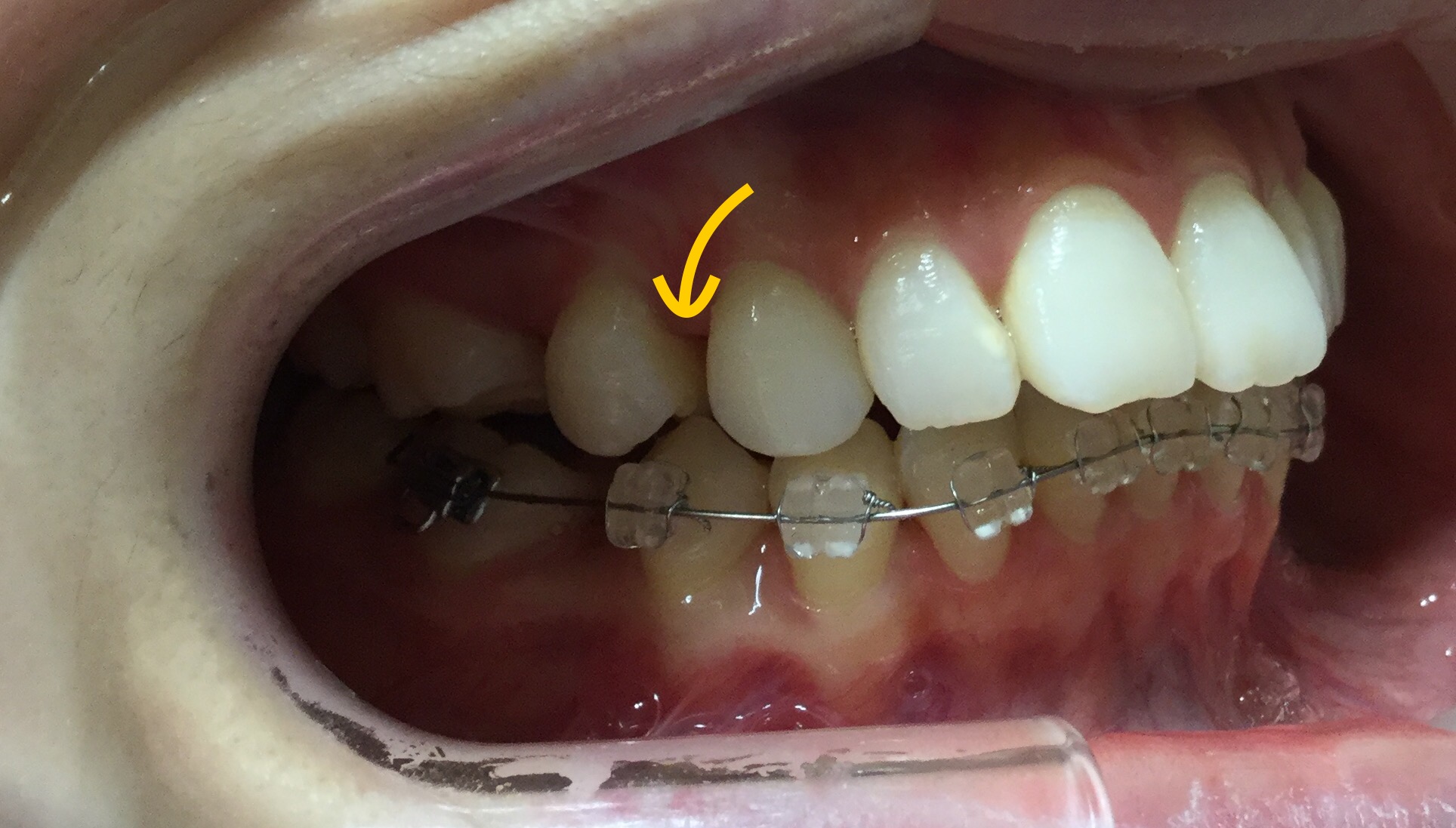 前歯２本が出ている症例（１ヶ月半後）