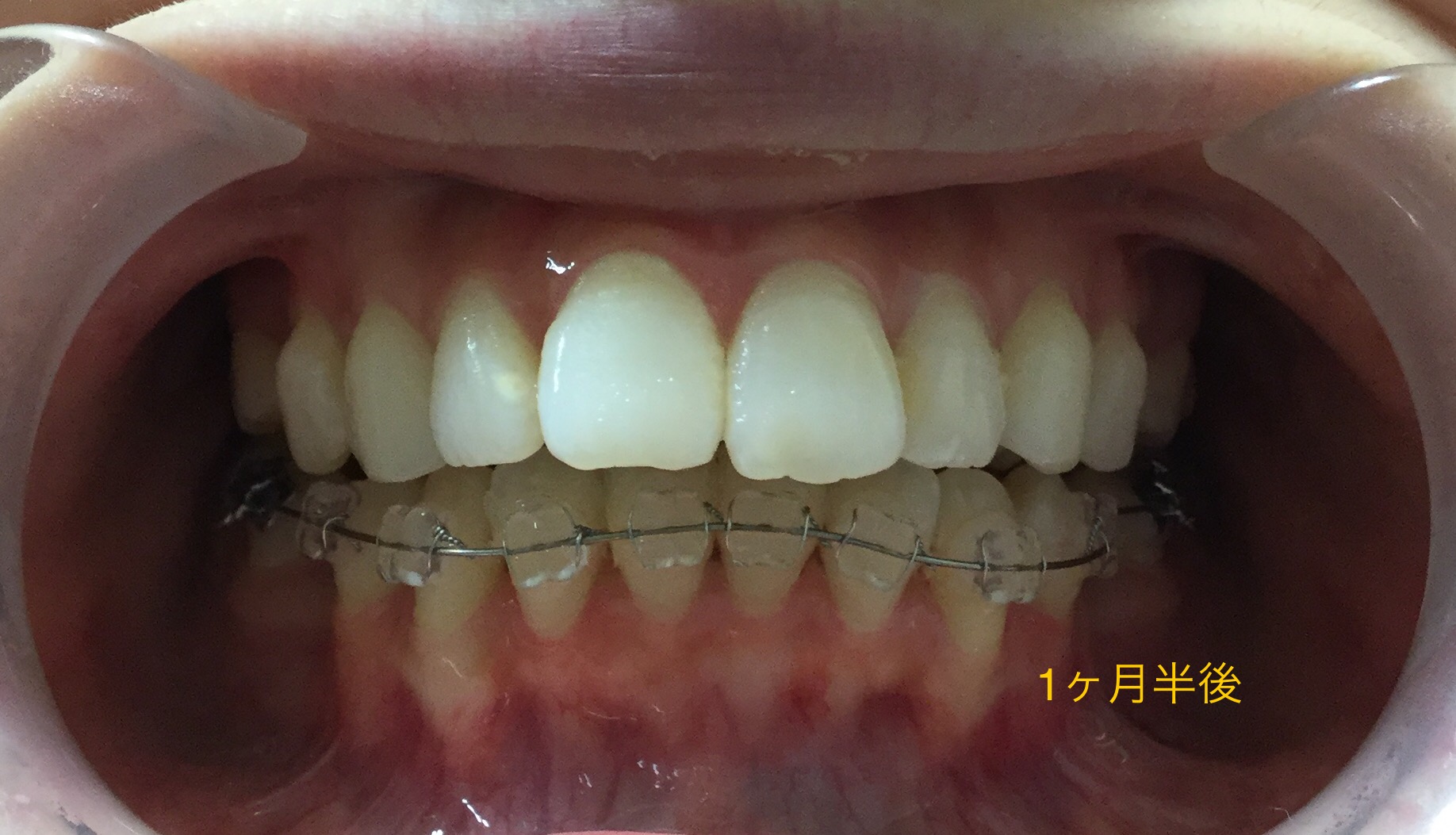 前歯２本が出ている症例（１ヶ月半後）