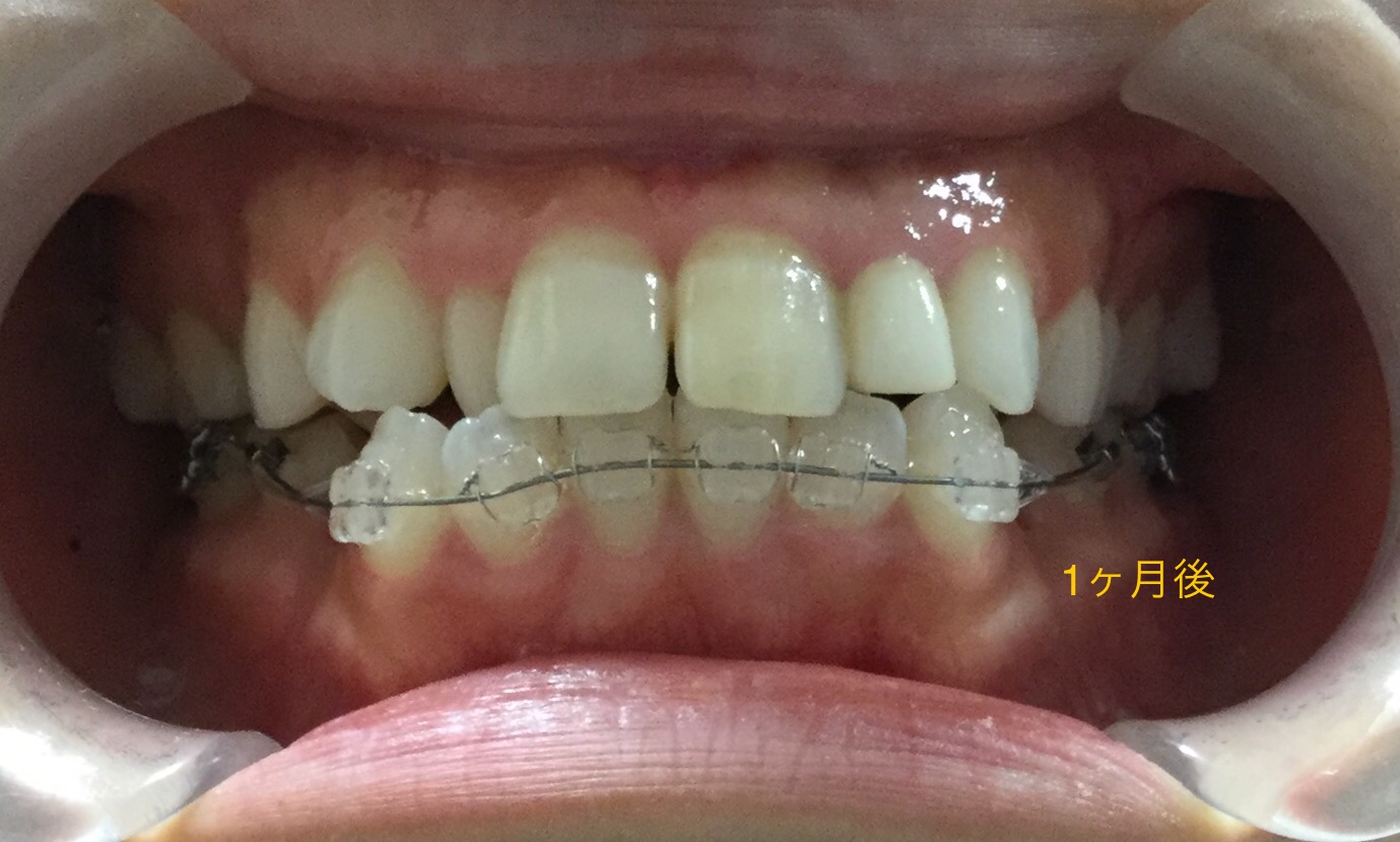 上顎が小さく、受け口っぽく見える症例(1ヶ月後）