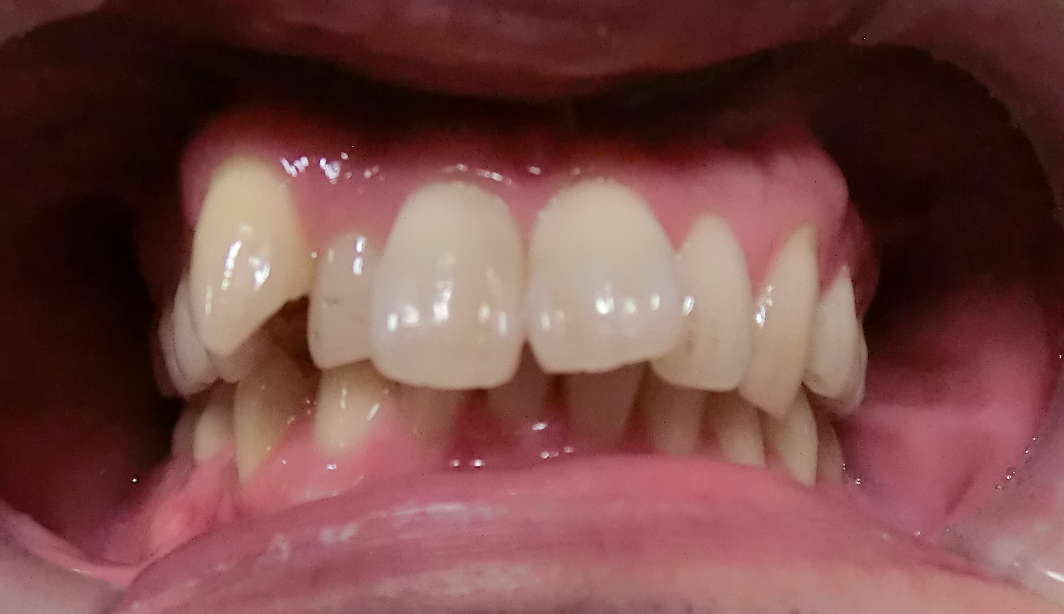 ３０代　出っ歯＋八重歯の改善
