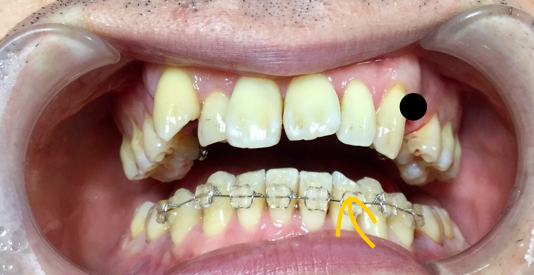 ３０代　出っ歯＋八重歯の改善（抜歯後）