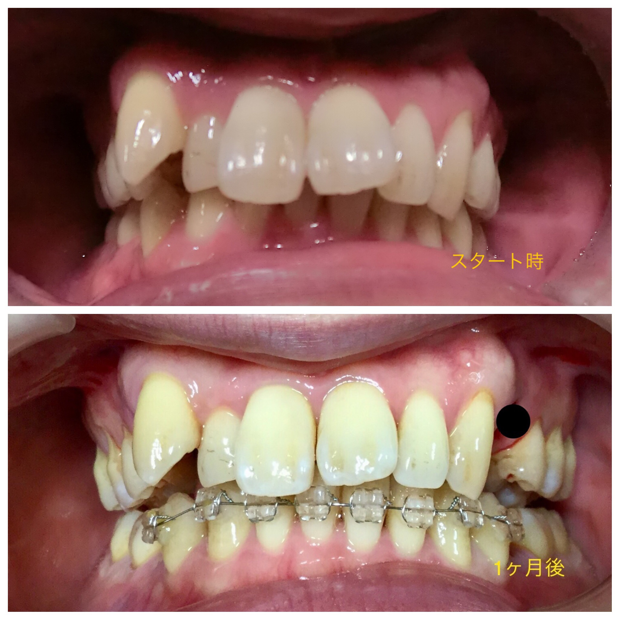 ３０代　出っ歯＋八重歯の改善（抜歯後）