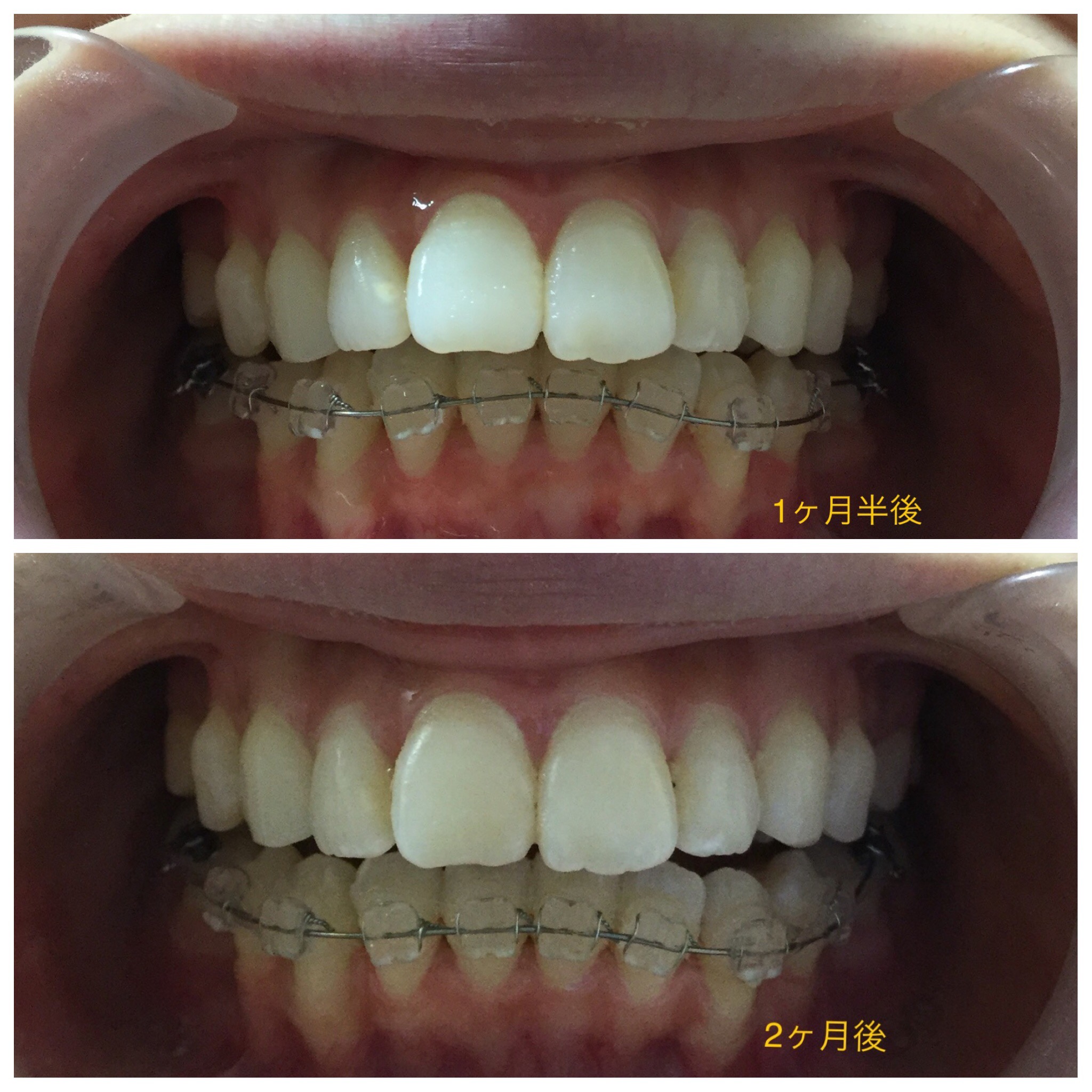 前歯２本が出ている症例（２ヶ月後）