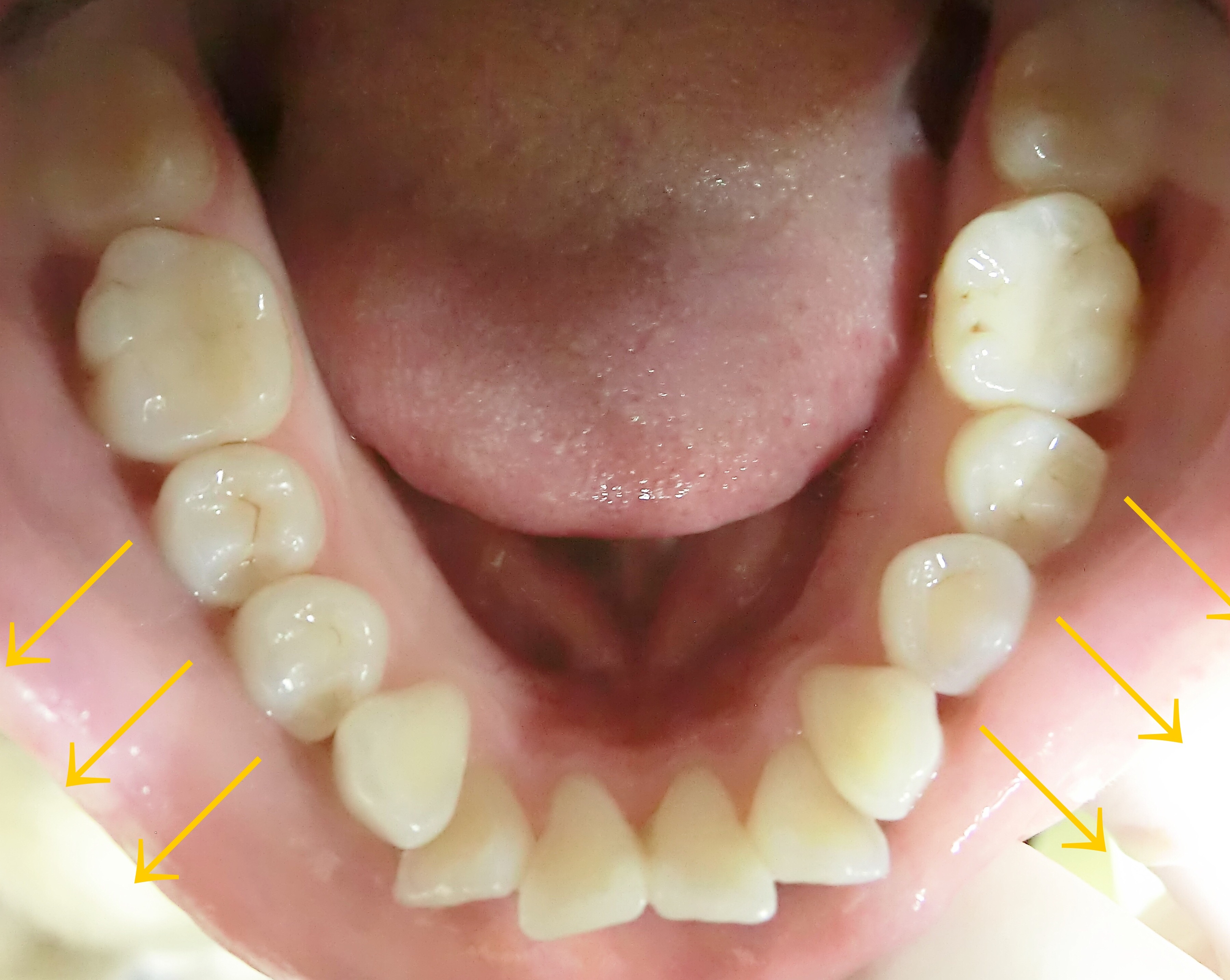 前歯２本が出ている症例（２ヶ月後）