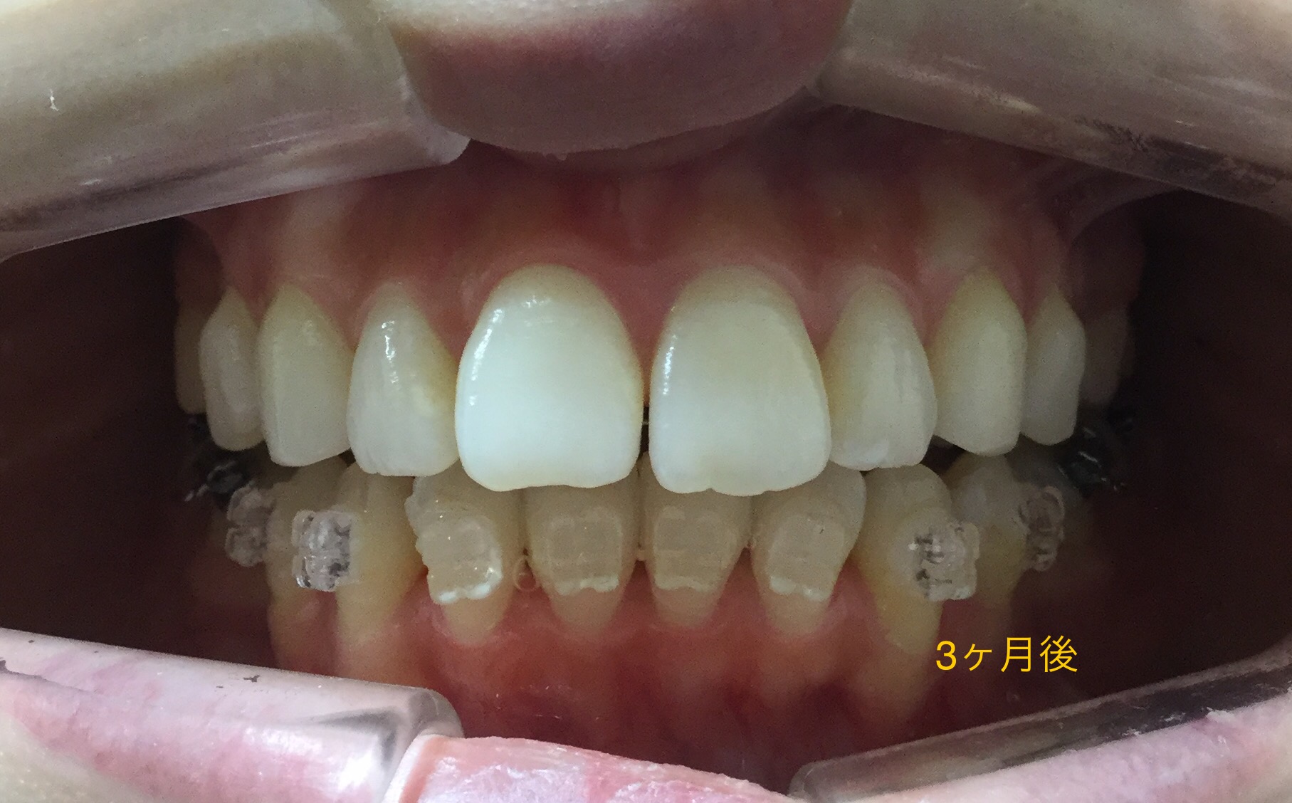 前歯２本が出ている症例（３ヶ月後）