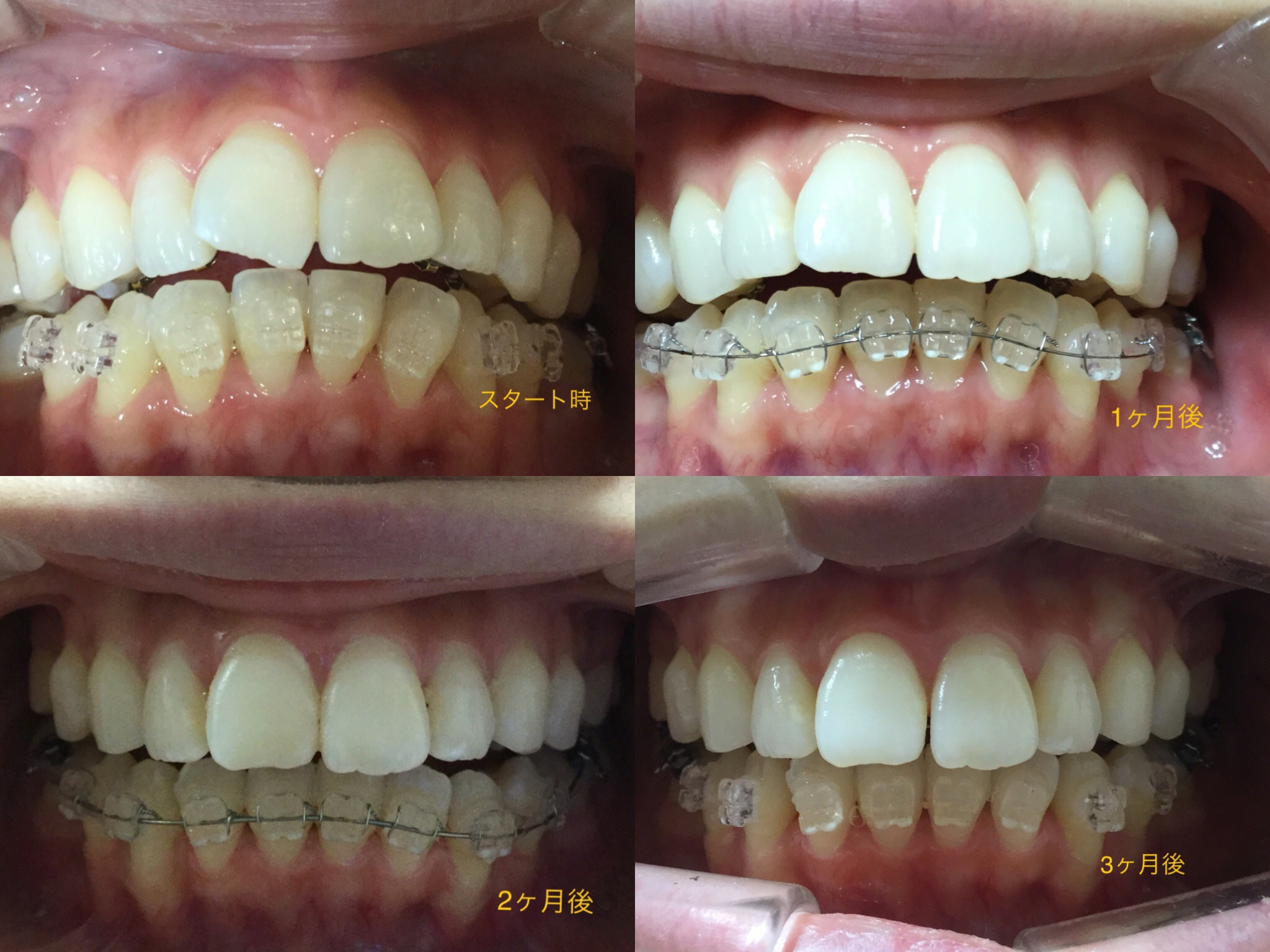前歯２本が出ている症例（３ヶ月後）
