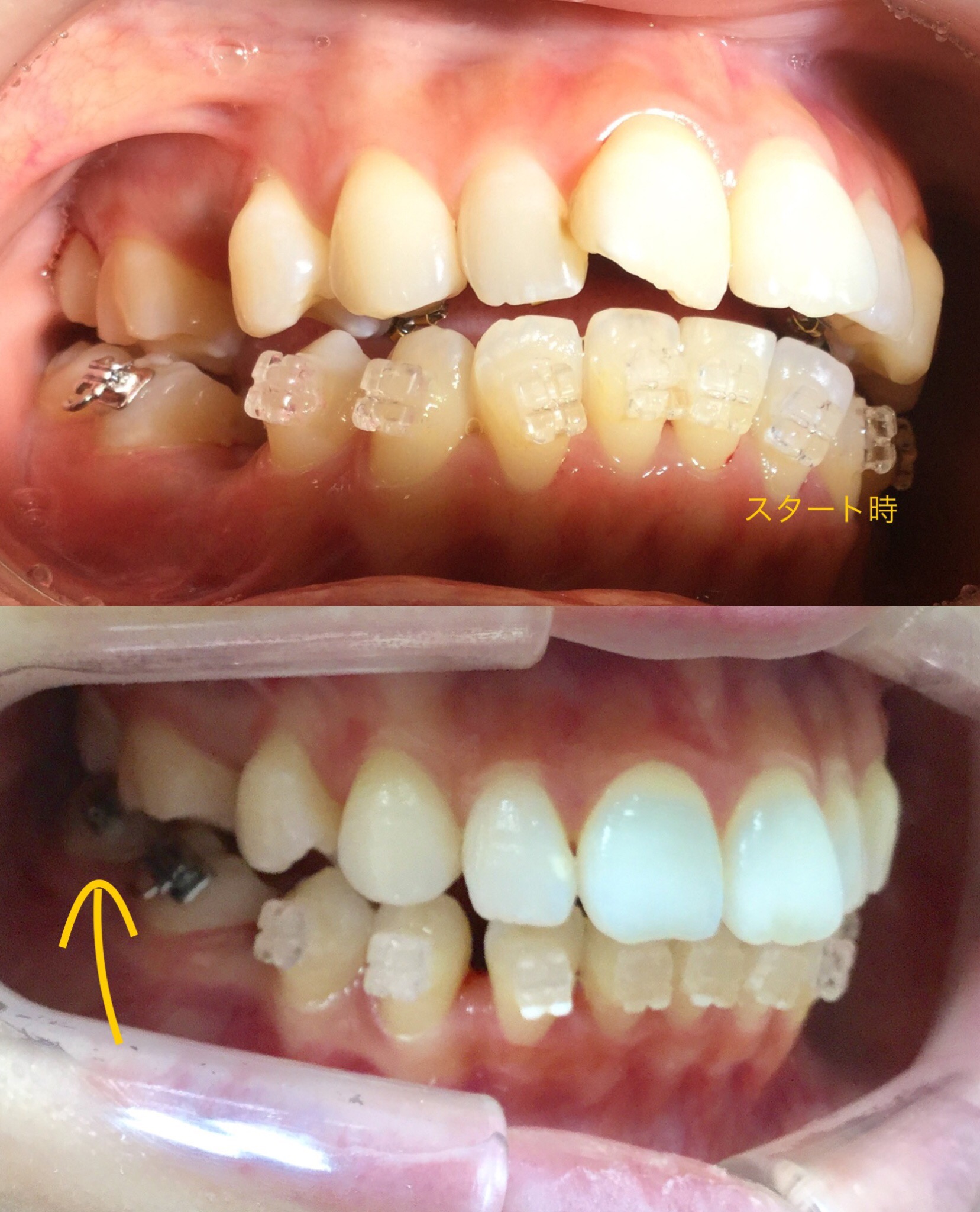 前歯２本が出ている症例（３ヶ月後）