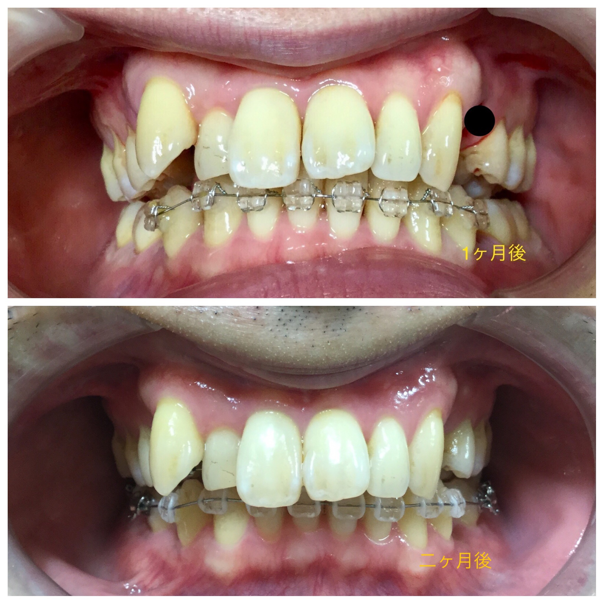 ３０代　出っ歯＋八重歯の改善（２ヶ月後）