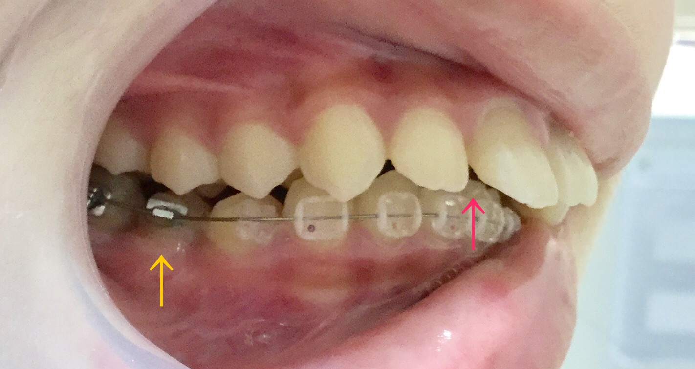 中学生　出っ歯＋ディープバイト症例(2ヶ月後）