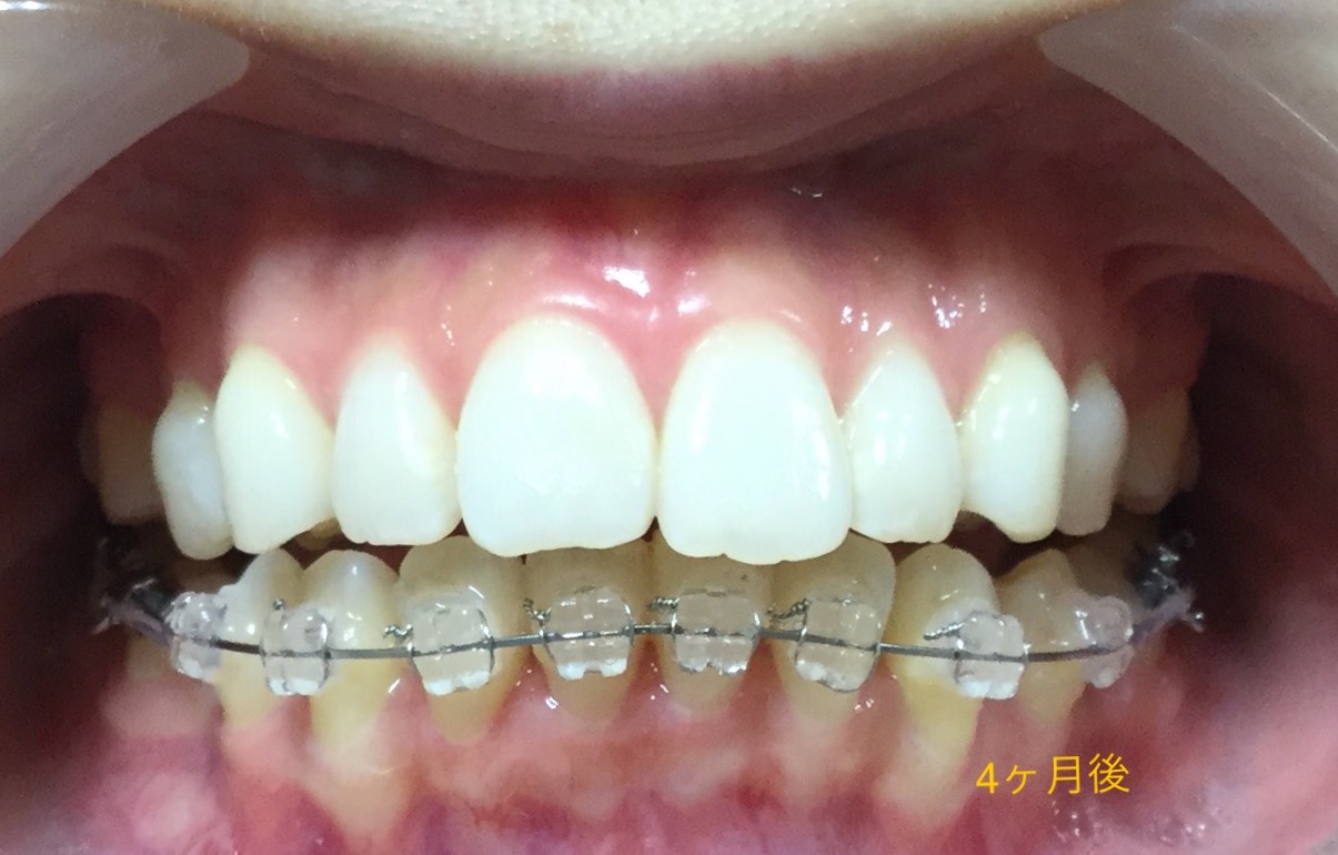 前歯２本が出ている症例（4ヶ月後）