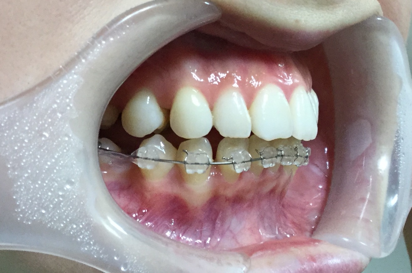 前歯２本が出ている症例（4ヶ月後）