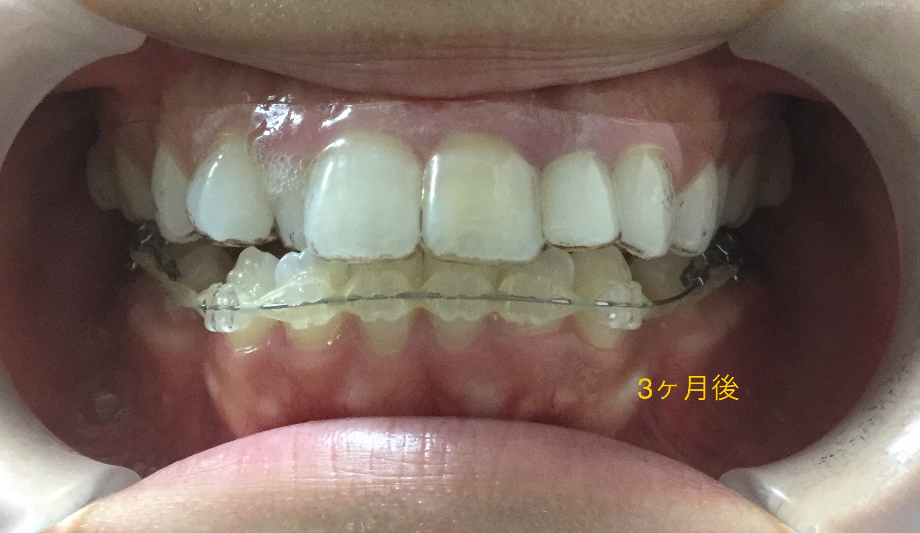上顎が小さく、受け口っぽく見える症例(3ヶ月後)