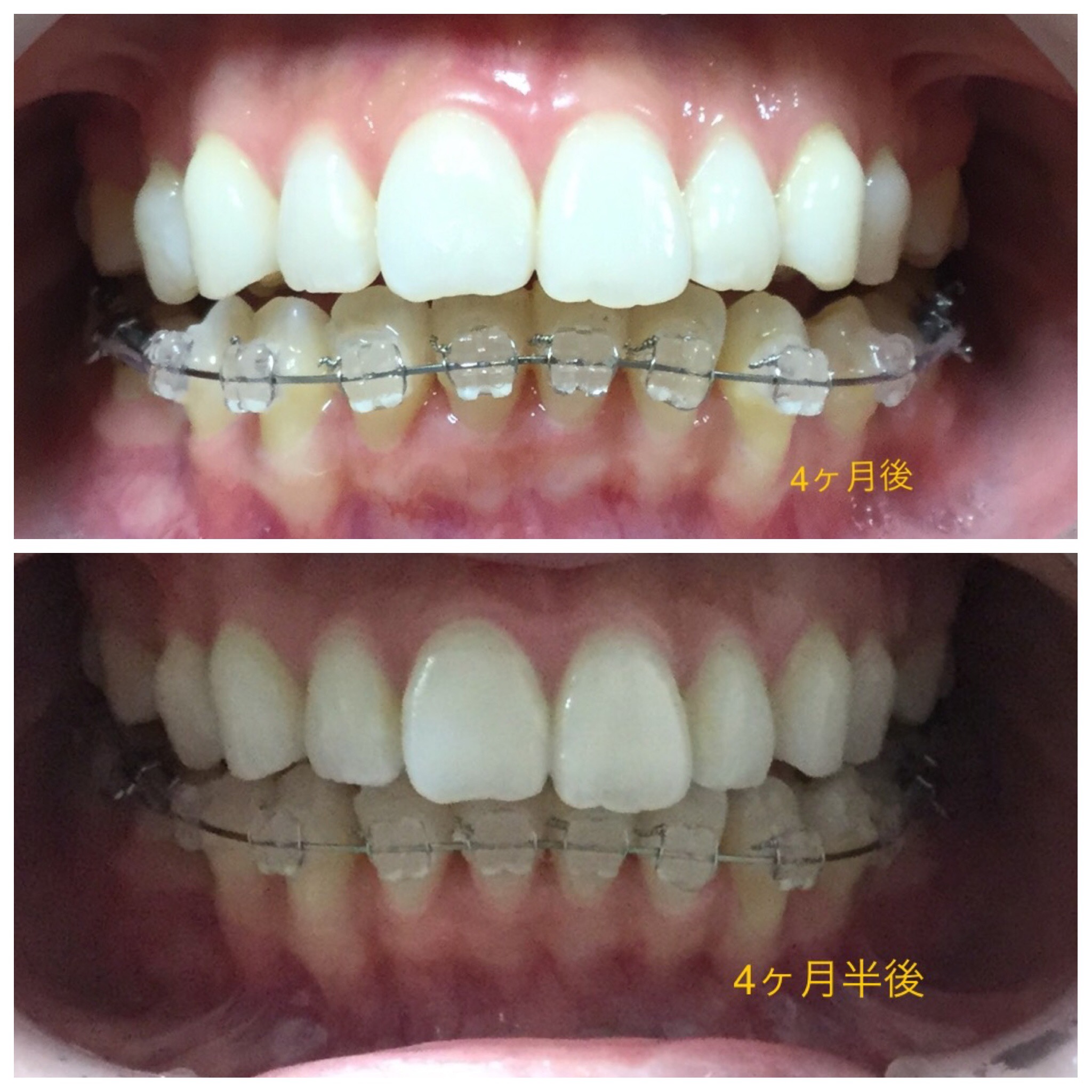 前歯２本が出ている症例（4ヶ月半後）