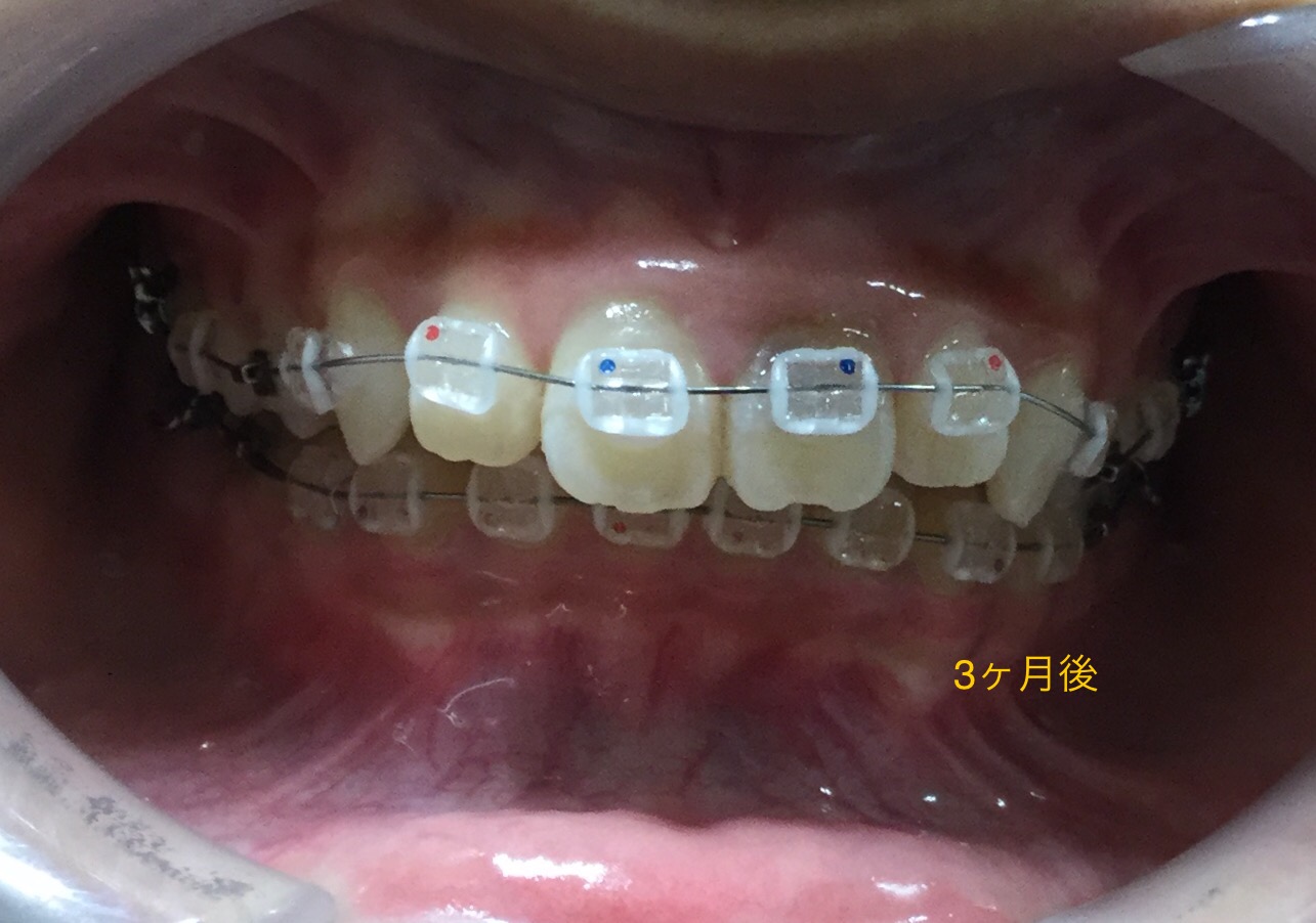中学生　出っ歯＋ディープバイト症例(3ヶ月後）
